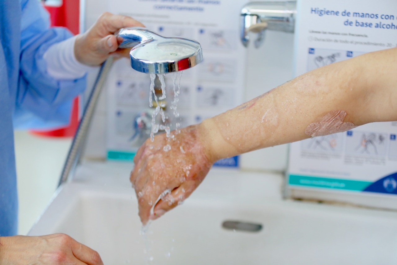 Sisol Salud te enseña qué hacer en caso de sufrir quemaduras