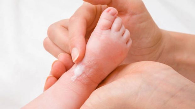 Sarpullido puede generar infecciones en la piel de los niños si no se trata a tiempo